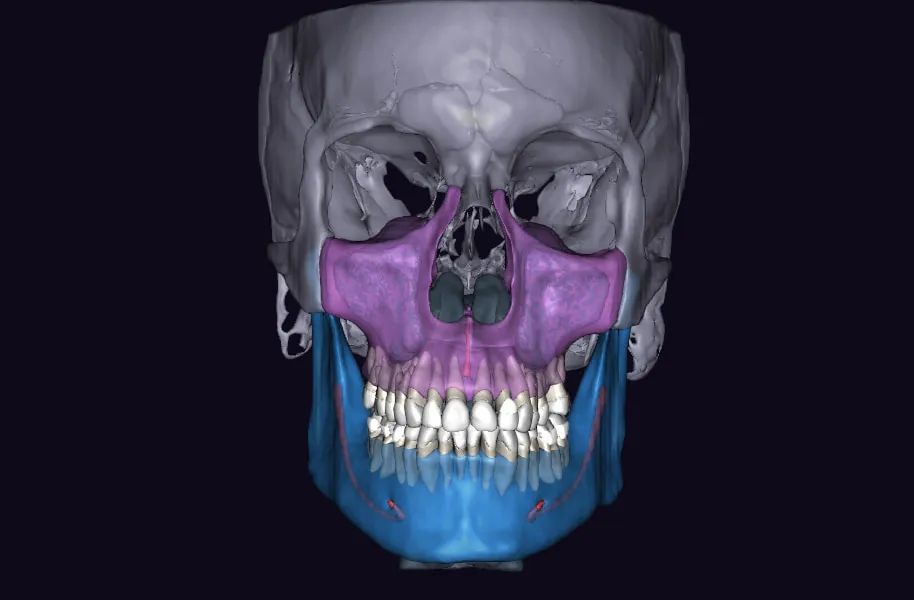 AI-segmented 3D CBCT scan showing color-coded maxilla, mandible, and dentition for All-on-X implant planning