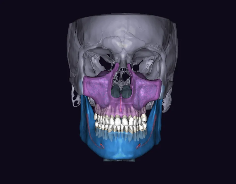 AI-segmented 3D CBCT scan — frontal view showing color-coded maxilla, mandible, and full dentition