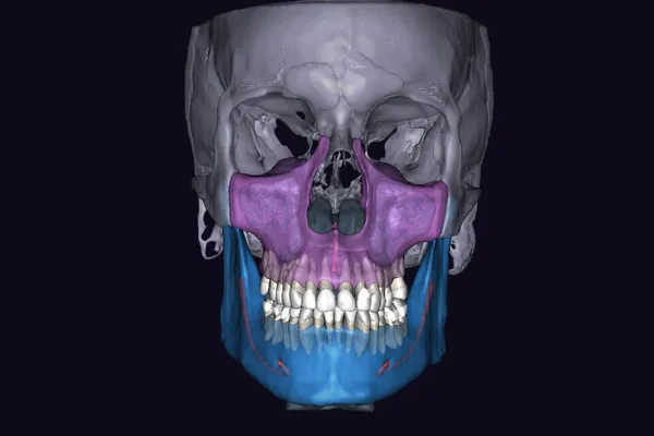 AI-segmented 3D CBCT scan showing color-coded maxilla, mandible, and dentition for All-on-X implant planning