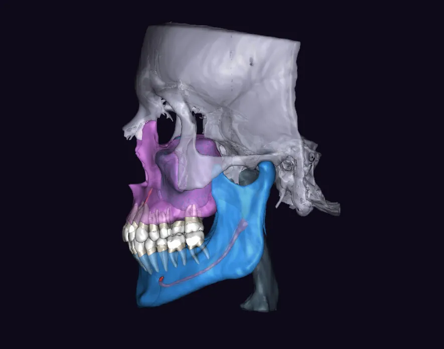 AI-segmented CBCT scan — left lateral profile showing maxillary and mandibular bone structure with dentition