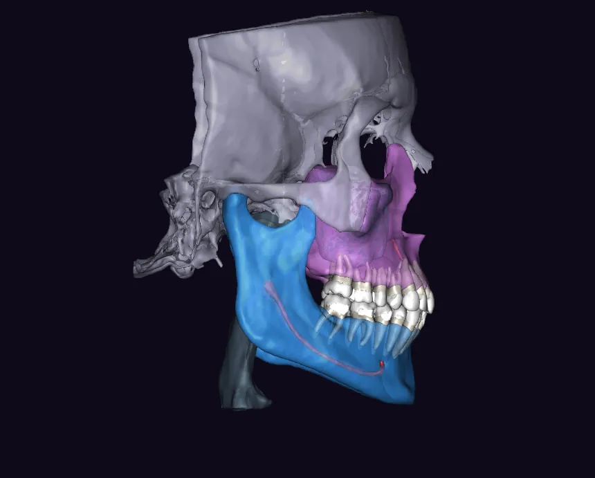 AI-segmented CBCT scan — right lateral profile showing jaw anatomy and tooth root positions