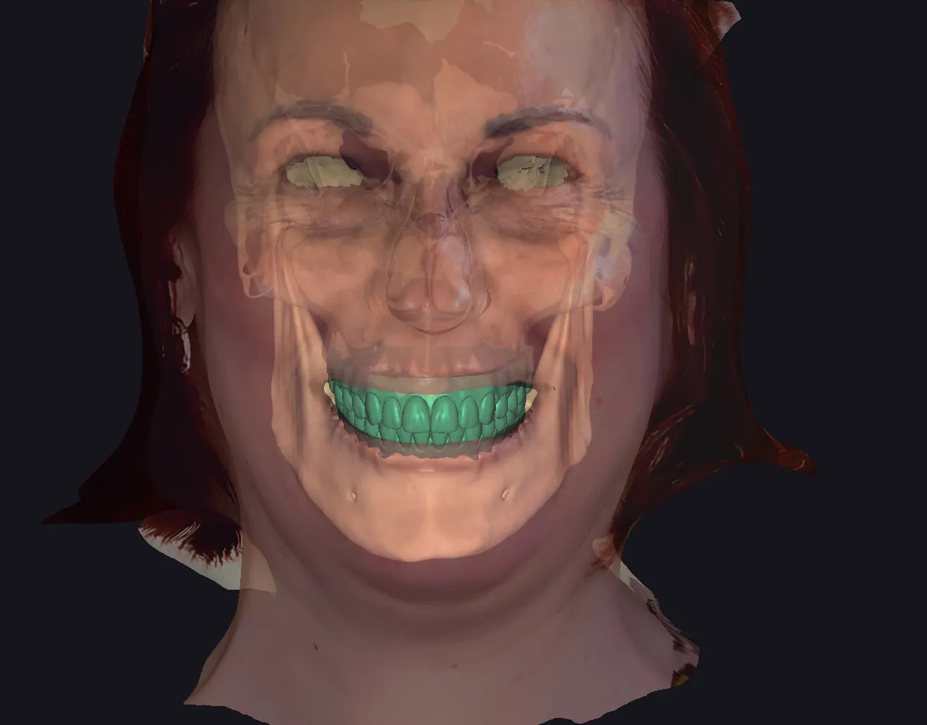 Digital face scan overlay with skeletal transparency showing proposed prosthetic waxup aligned to patient smile