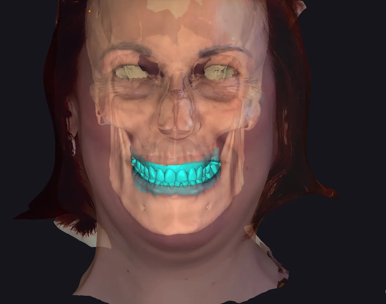Pre-operative face scan overlay showing finalized prosthetic design with skeletal reference for surgical planning