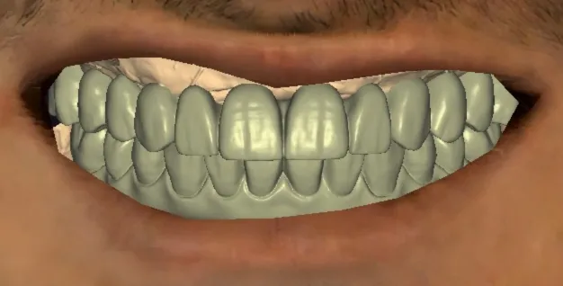 Digital scan overlay showing prosthetic design alignment mapped to the patient's dental arch