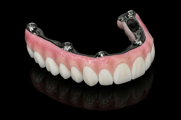 Full-arch zirconia prosthesis on a polished titanium bar with screw access cylinders, on a black reflective surface