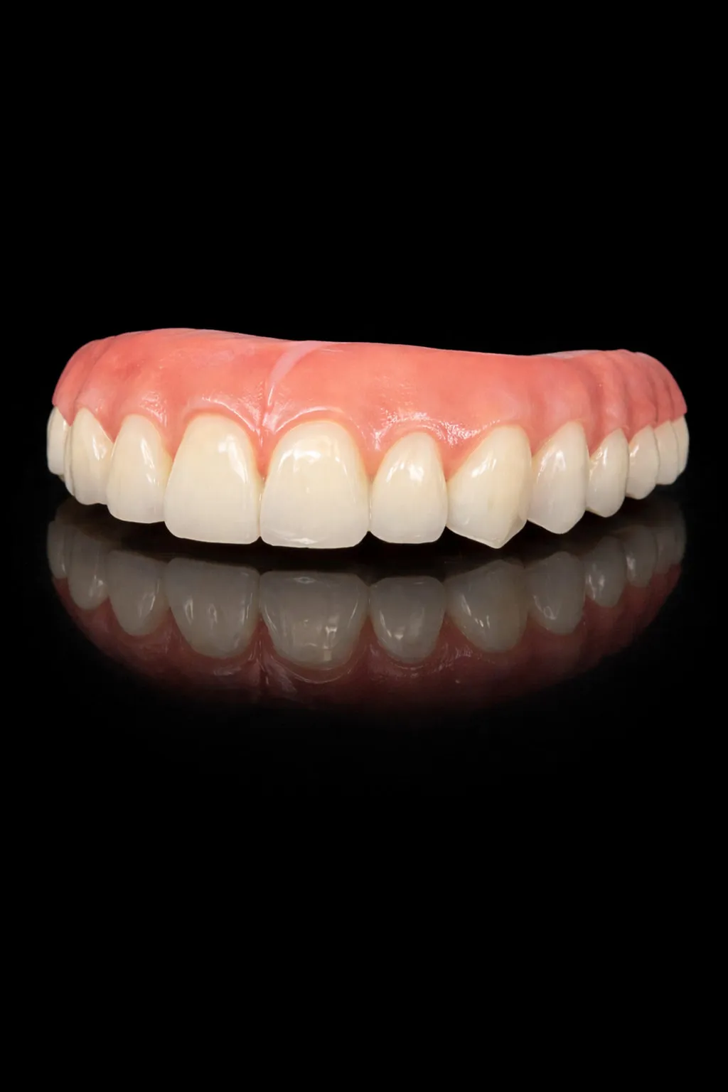Upper arch All-on-X prosthetic showing detailed gingival staining and tissue characterization
