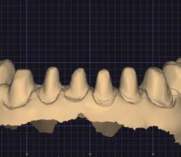 3D digital scan of a lower dental arch showing prepared teeth from the lingual view