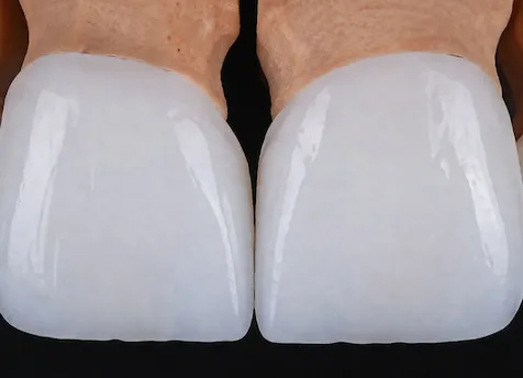Real emax and zirconia crowns — precision single-unit restorations designed and fabricated in-house