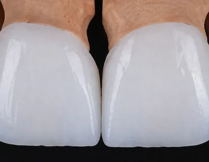 Precision dental crown on a digital design model