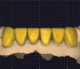 CAD-designed lower anterior crowns highlighted in gold on a digital dental arch scan