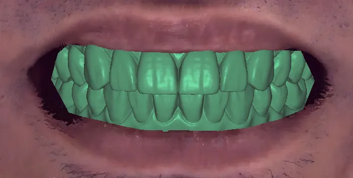 Digital waxup overlay showing proposed final tooth anatomy mapped to the clinical situation