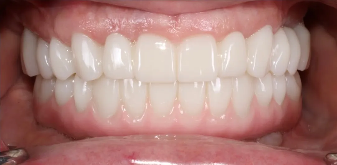 Retracted view of the final FP1 prosthesis, a tooth-only full-arch restoration