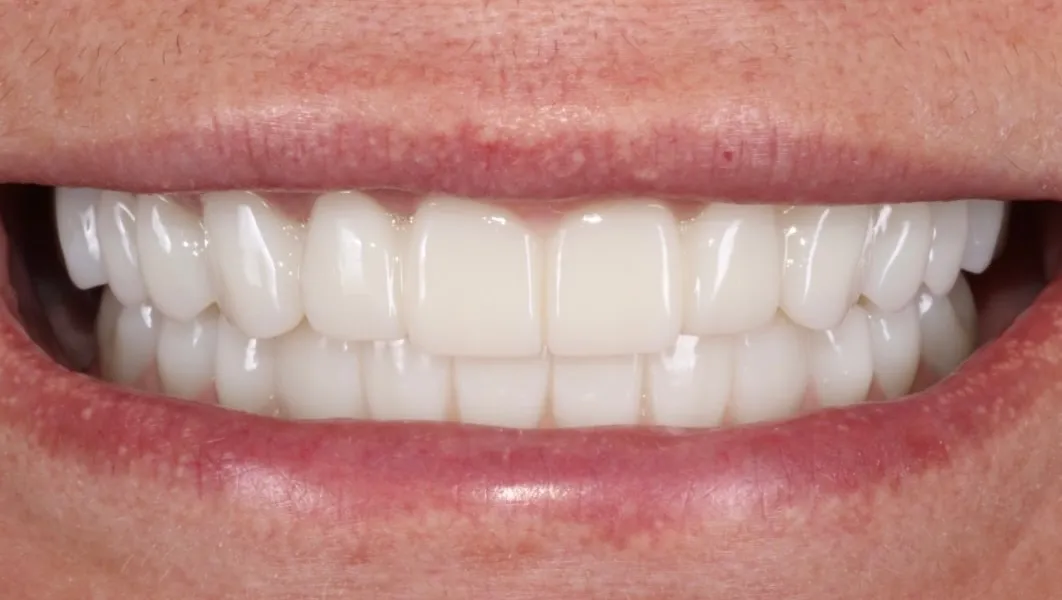 Final smile with an FP1 full-arch prosthesis showing natural-looking teeth and no prosthetic gingiva