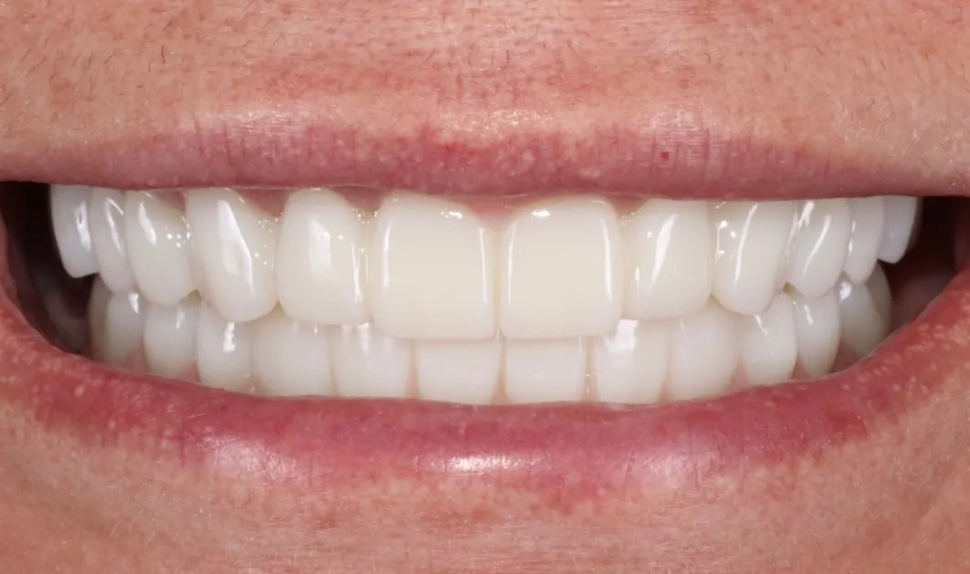 Final smile with the FP1 full-arch prosthesis in place