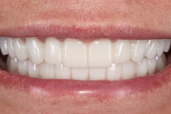 Final smile with an FP1 full-arch prosthesis showing natural-looking teeth and no prosthetic gingiva