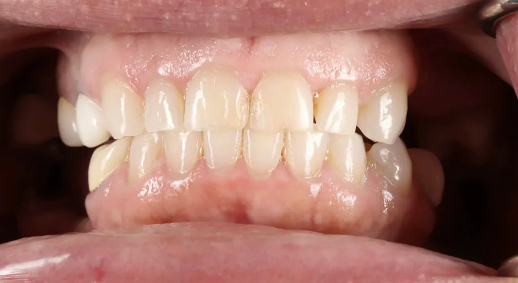 Pre-operative retracted view of the natural dentition before treatment