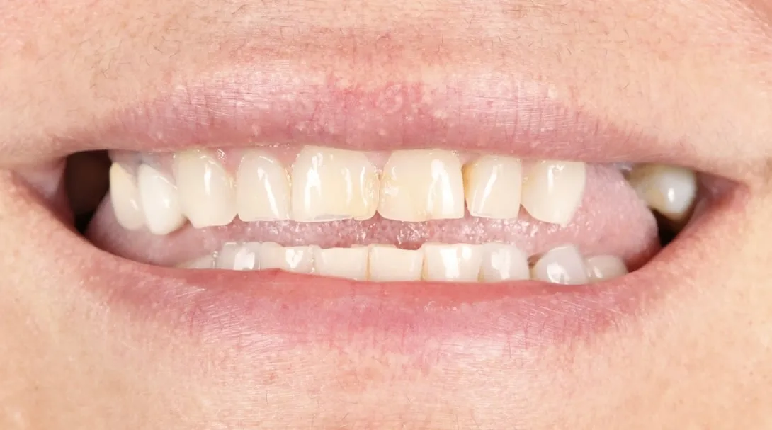 Pre-operative smile showing worn, discolored natural teeth with posterior gaps
